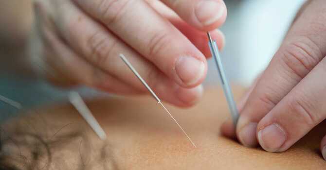 Dry Needling
